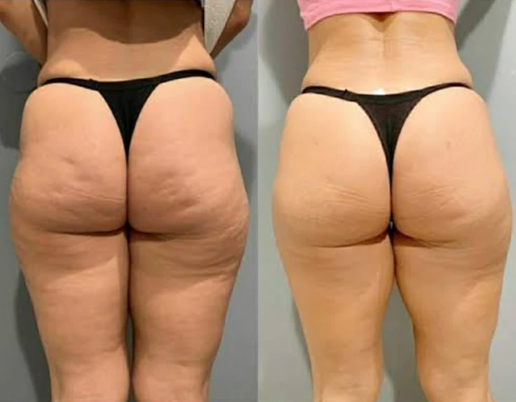 Antes e depois: celulite no bumbum e nas coxas