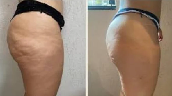 Antes e depois: celulite na coxa e no bumbum, vista lateral