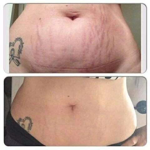 Antes e depois: estrias na barriga