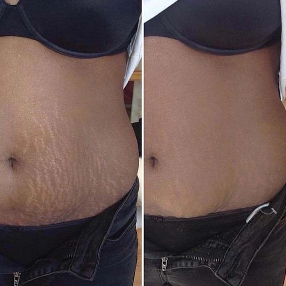 Antes e depois: estrias na lateral da barriga