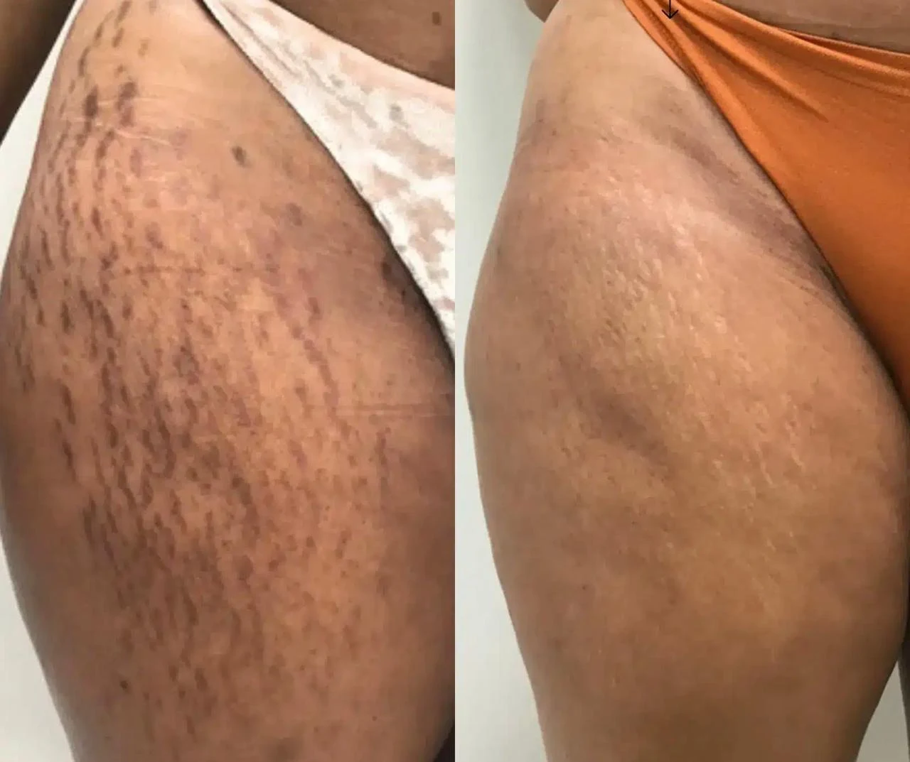 Antes e depois: estrias na lateral da coxa
