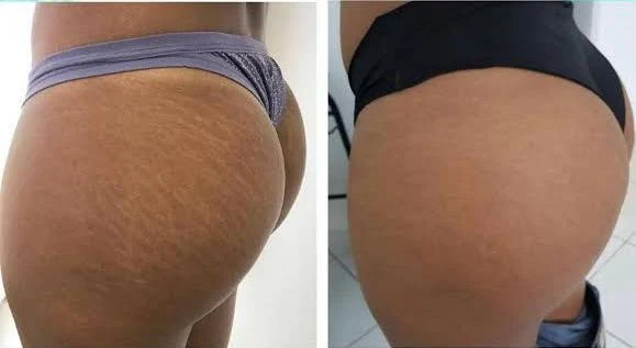 Antes e depois: estrias nos glúteos