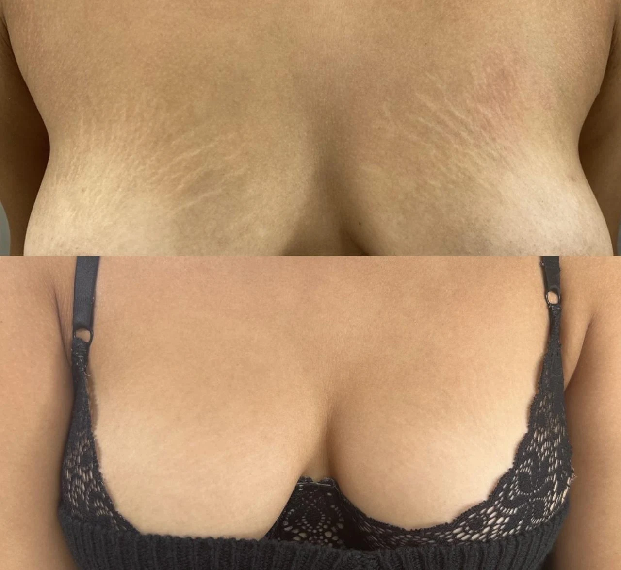 Antes e depois: estrias nos seios