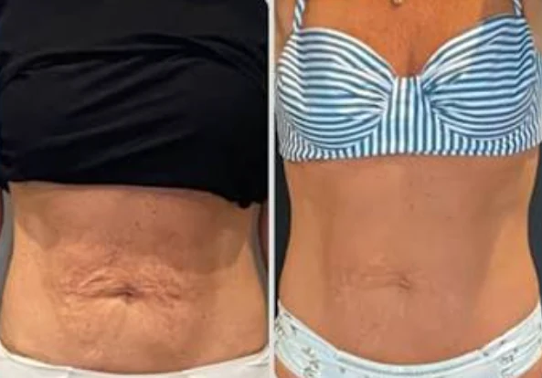 Antes e depois: flacidez na barriga