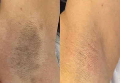 Antes e depois: manchas escuras nas axilas