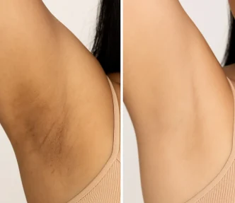 Antes e depois: manchas escuras nas axilas