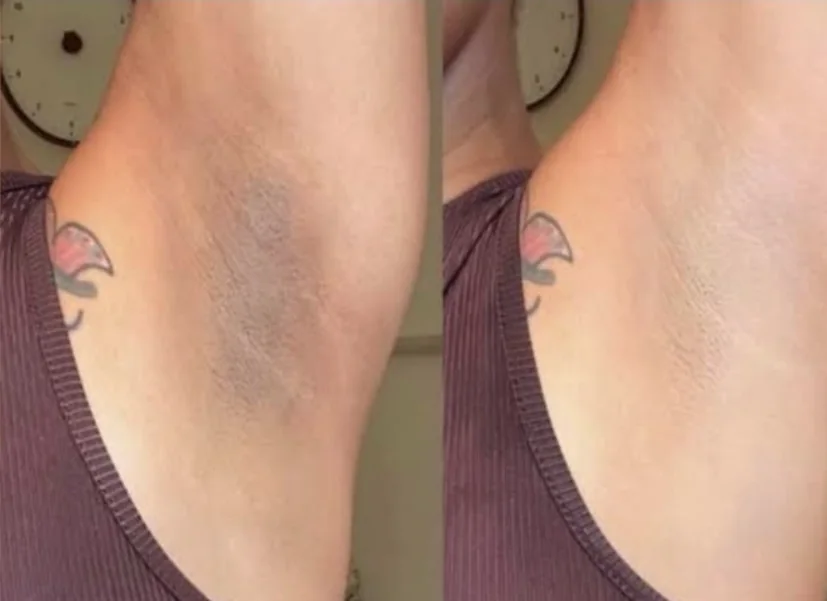 Antes e depois: manchas escuras nas axilas